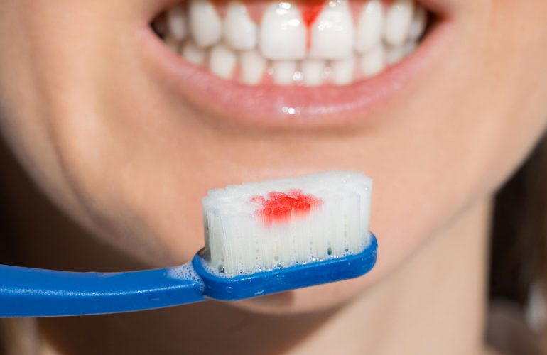 Dişeti Hastalıkları ve Belirtileri Nelerdir? Dişeti kanaması Simyadent Dişeti sağlığı Periodontoloji