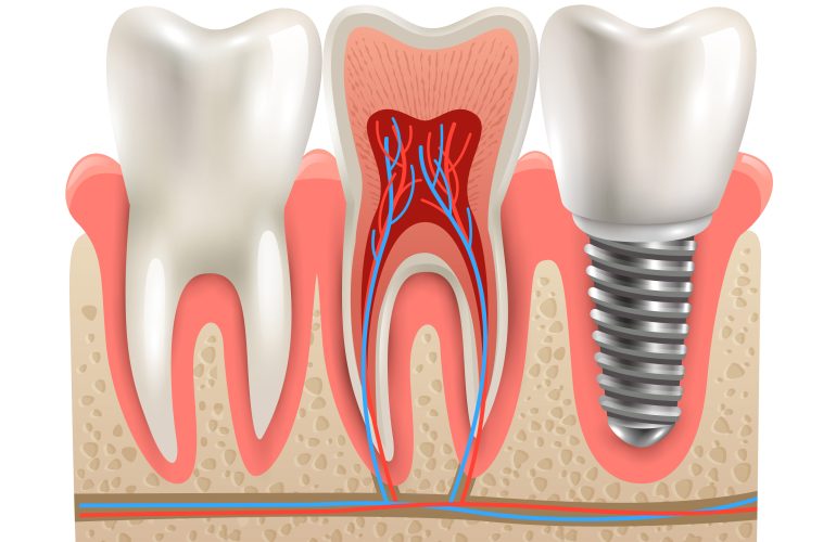 İmplant Tedavinizi Geciktirmeyin! implant tedavisi ankara
