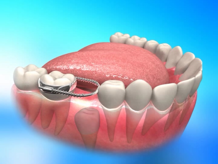 Çocuklarda Yer Tutucu Uygulaması ve Önemi Yer Tutucu