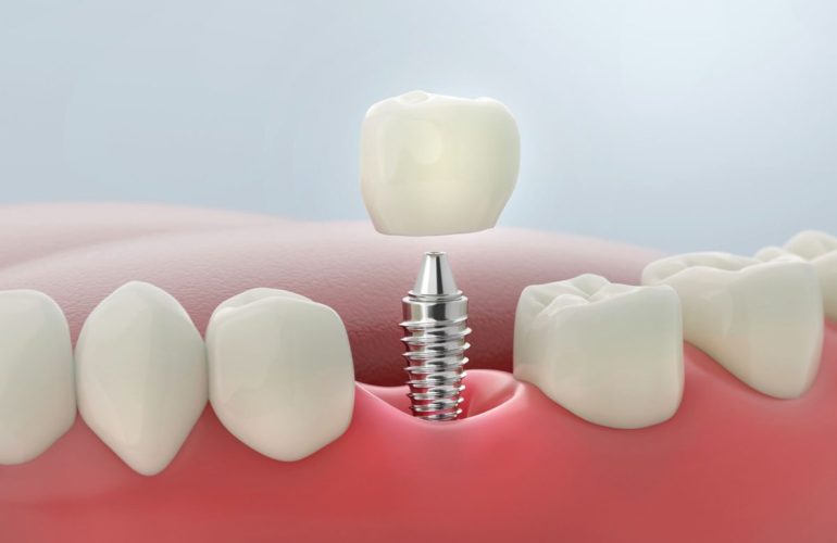 Ankara İmplant Fiyatları 2026 ankara dis implant