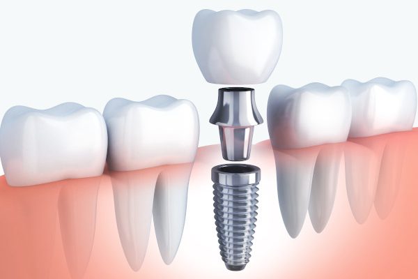 Ankara Diş İmplant Fiyatları 2025 implant fiyatları