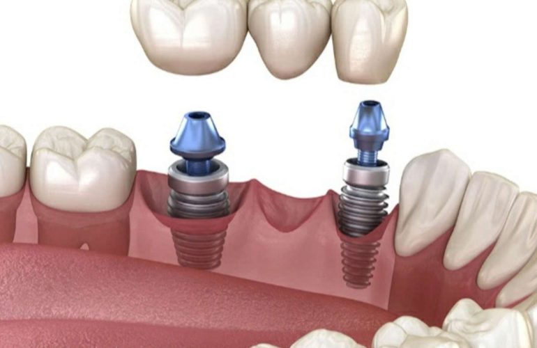 İmplant Tedavisi Sonrası Yaşam Ankara Implant Tedavisi Sonrasi