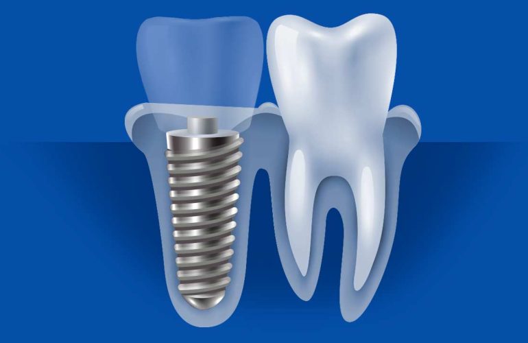 Titanyum İmplant Nedir? Kimler İçin Uygundur? Titanyum Implant