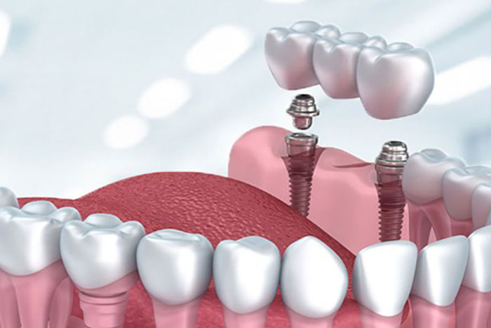 Çelik İmplant Nedir? Kimler İçin Uygundur? Celik Implant Nedir Kimler Icin Uygundur