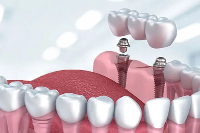 Ankara İmplant Tedavisi: Diş Eksikliğine Kalıcı Çözüm Celik Implant