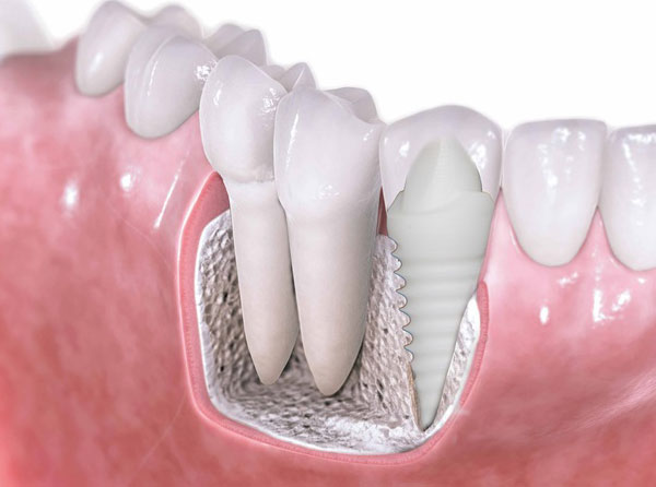 Ankara İmplant Tedavisi: Diş Eksikliğine Kalıcı Çözüm Zirkonyum Implantlar