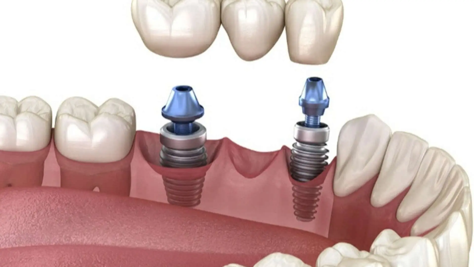 Ankara İmplant Tedavisi: Diş Eksikliğine Kalıcı Çözüm Ankara implant dental