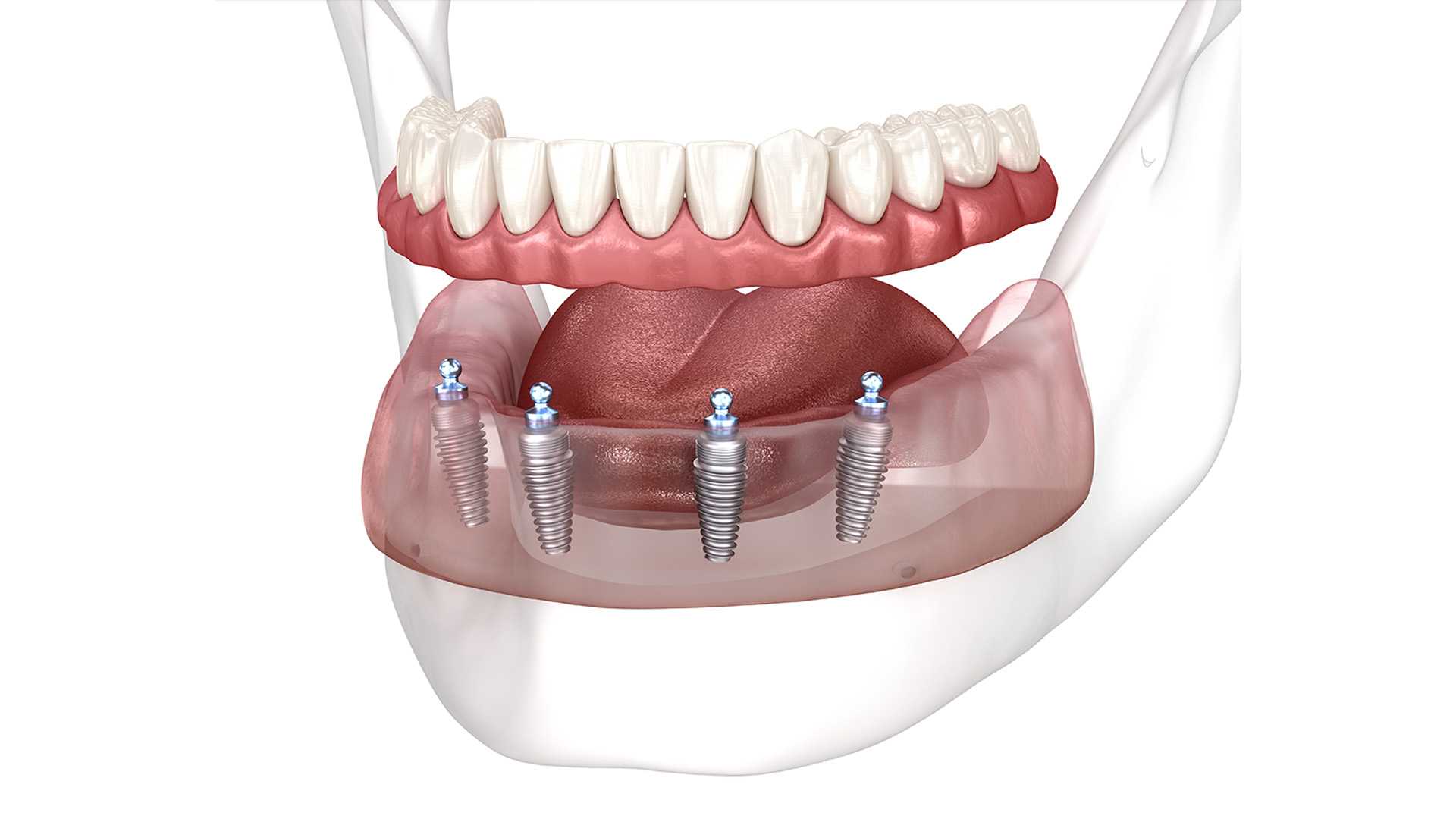Ankara İmplant Tedavisi: Diş Eksikliğine Kalıcı Çözüm Ankara diş implant