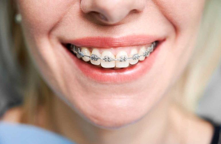 Ortodonti Tedavisi Sonrası Yapılması Gerekenler Ortodonti Tedavisi Sonrasi Yapilmasi Gerekenler