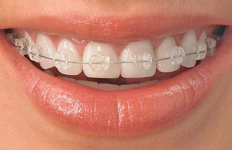 Şeffaf Braketler Nedir? Kimler İçin Uygundur? Seffaf Braketler