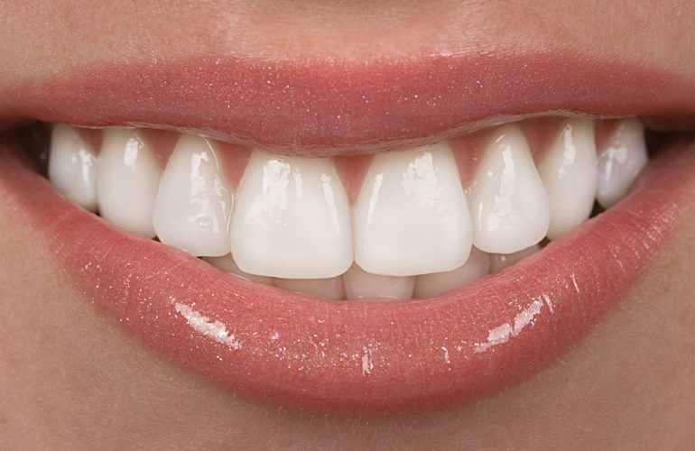 Gummy Smile Tedavisi Gummy Smile Tedavisi