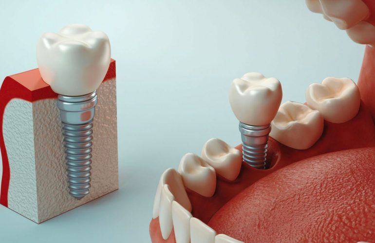 İmplant Aşamaları: Diş Sağlığında Yenilikçi Çözümler Implant Asamalari Dis Sagliginda Yenilikci Cozumler
