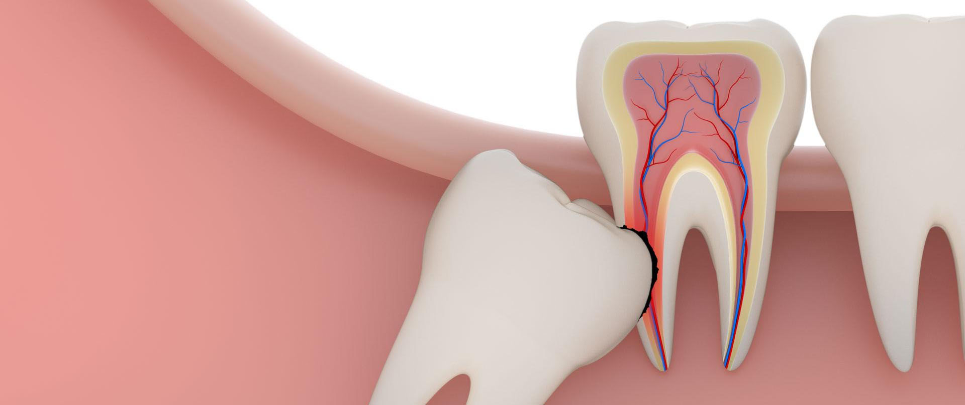 Damakta Gömülü Diş Ameliyatı: Süreç, Riskler ve İyileşme Damakta Gomulu Dis Ameliyati