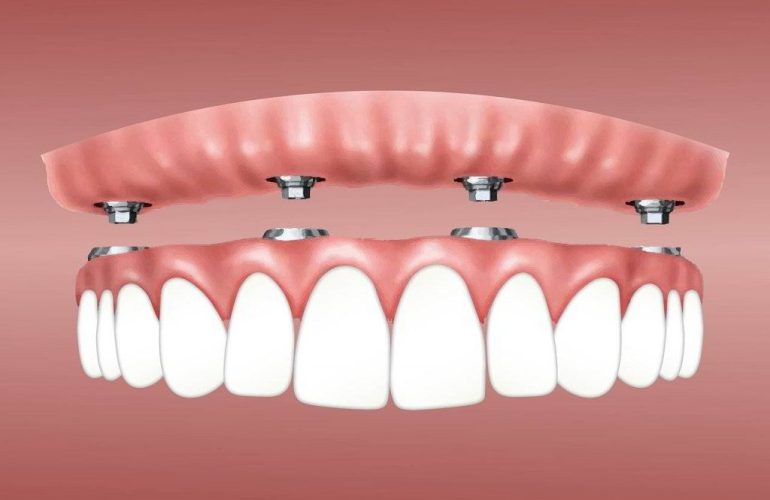 İmplant Diş Bakımı Nasıl Yapılır? Implant Dis Bakimi Nasil Yapilir