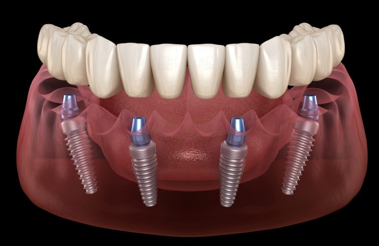 İmplant İyileşme Başlığı Nasıl Takılır? Implant Iyilesme Basligi Nasil Takilir