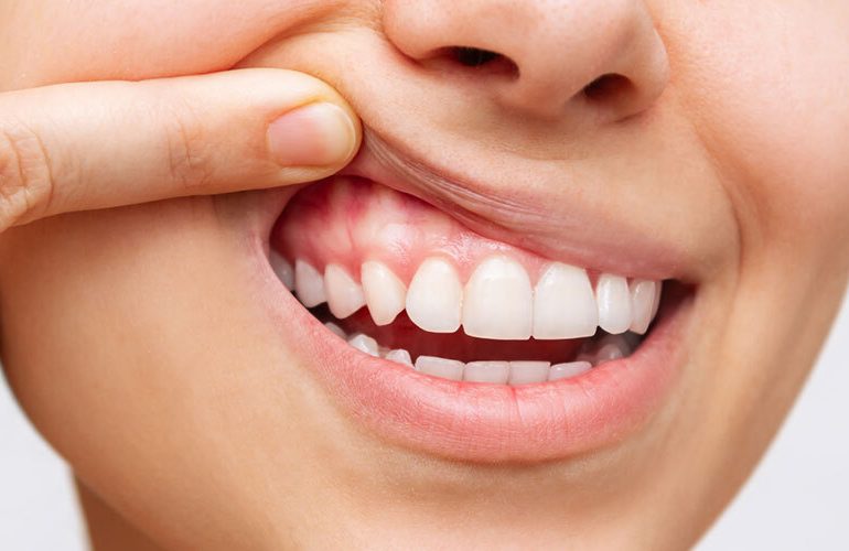 Implant Sonrasi Dis Eti Beyazlamasi​