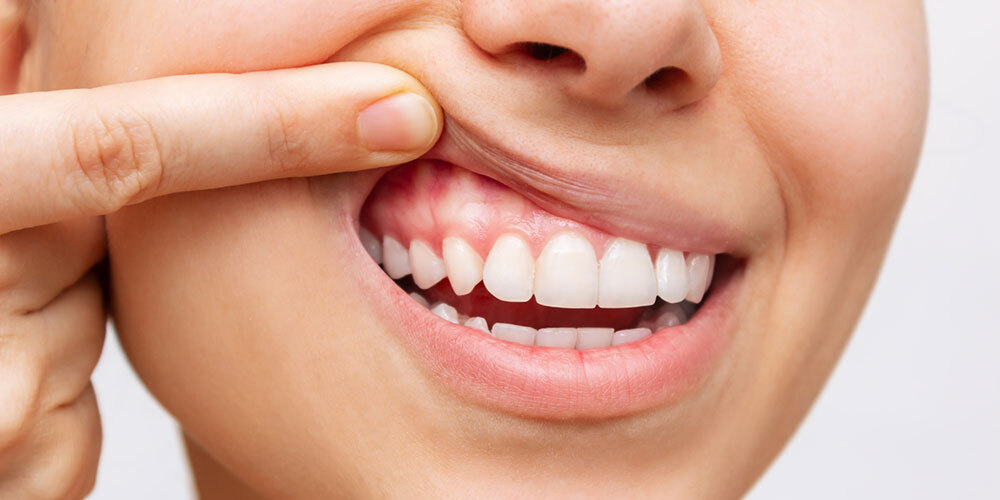 Implant Sonrasi Dis Eti Beyazlamasi​