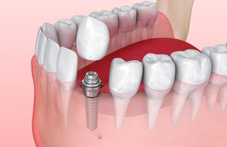 İmplant Vidası Takıldıktan Sonra Ağrı Implant Vidasi Takildiktan Sonra Agri