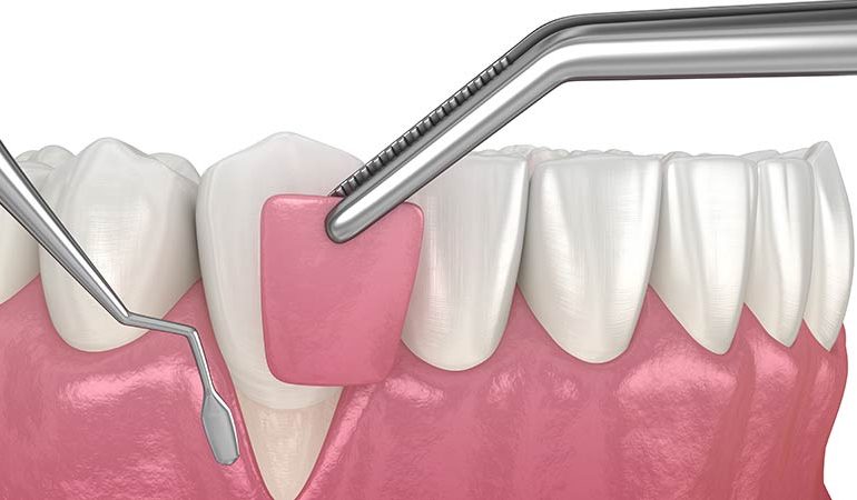 Diş Eti Çekilmesinde İmplant Yapılır mı? diseti cekilmesi varsa implant yapilir mi