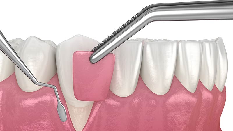 diseti cekilmesi varsa implant yapilir mi