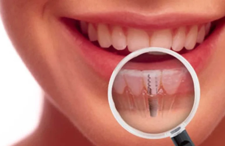 implant sonrasi dis eti sismesi​