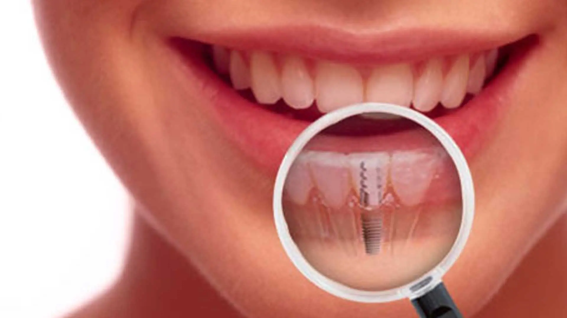 implant sonrasi dis eti sismesi​