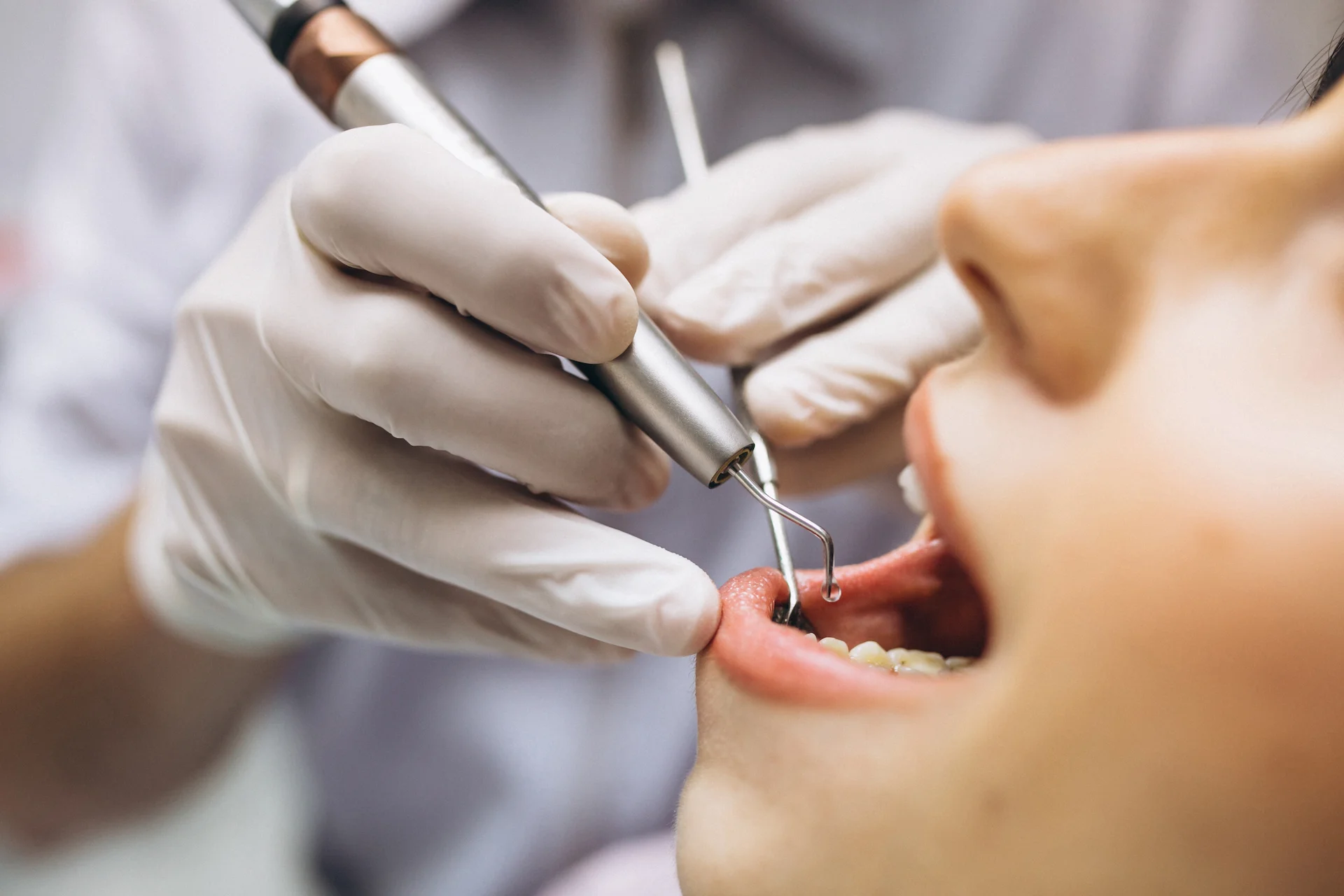 Ankara Periodontoloji: Diş Eti Sağlığınız İçin Kapsamlı Rehber Ankarada Periodontoloji