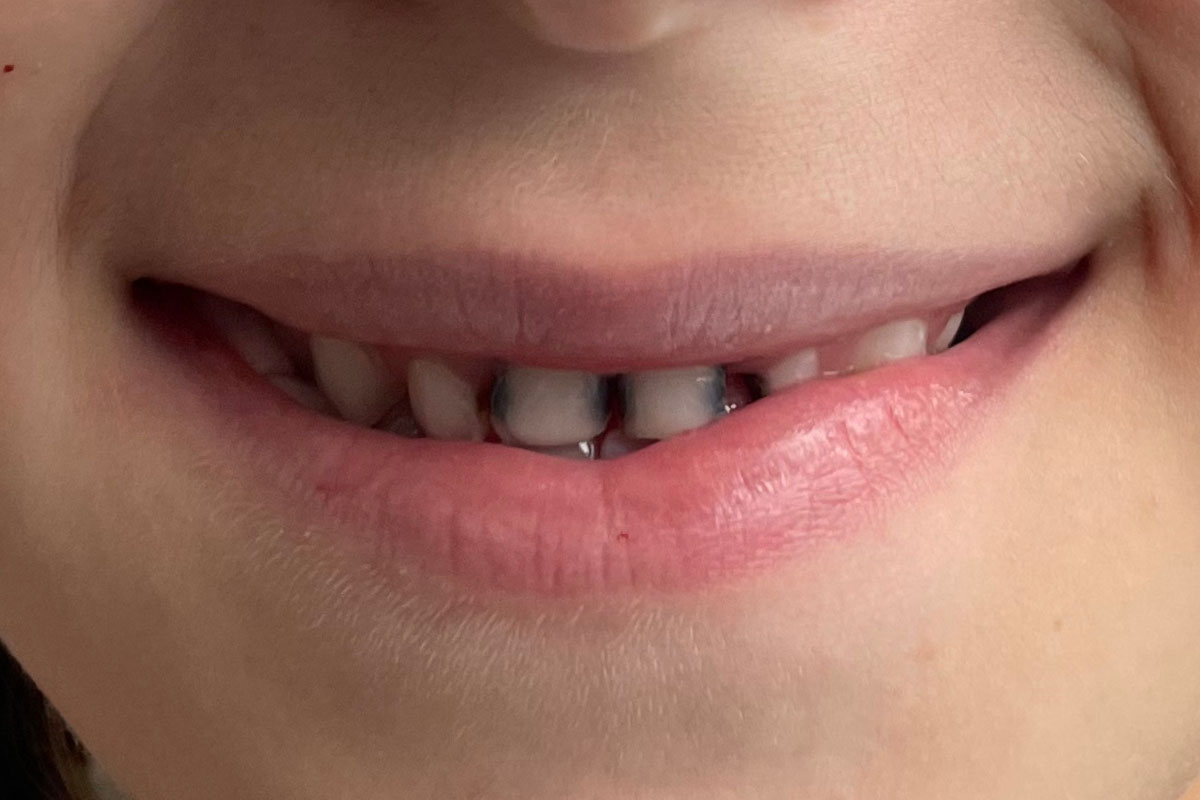 Ön Diş Çürüğü Nasıl Tedavi Edilir? On Dis Curugu Nasil Tedavi Edilir