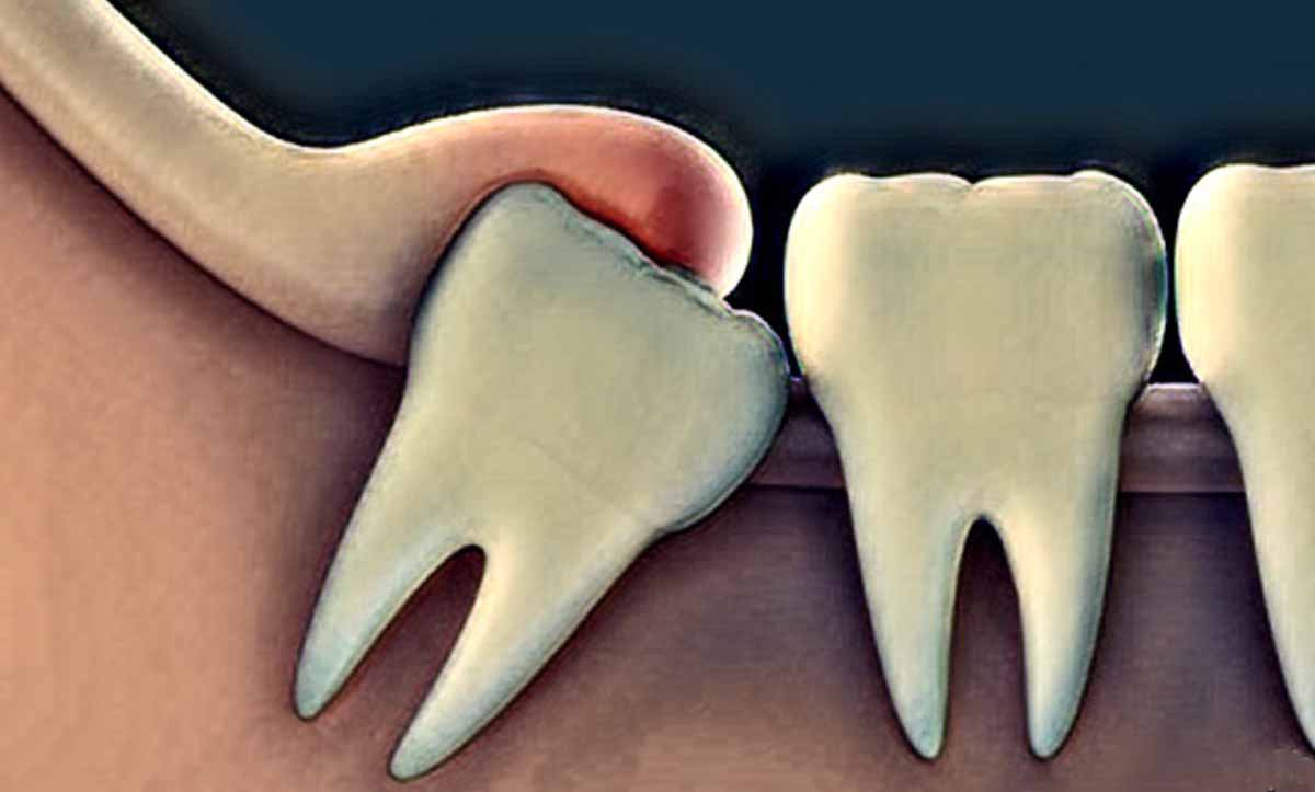 Yarı Gömülü 20’lik Diş Belirtileri, Tedavi Yöntemleri Yari Gomulu 20lik Dis Belirtileri