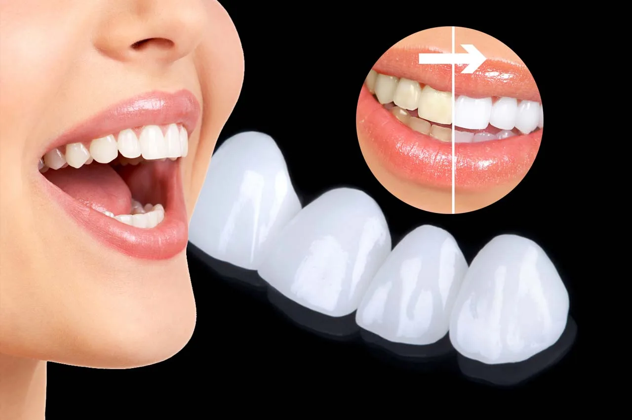 Zirkonyum Kaplama: Diş Estetiğinde Mükemmel Çözüm Zirkonyum Kaplama