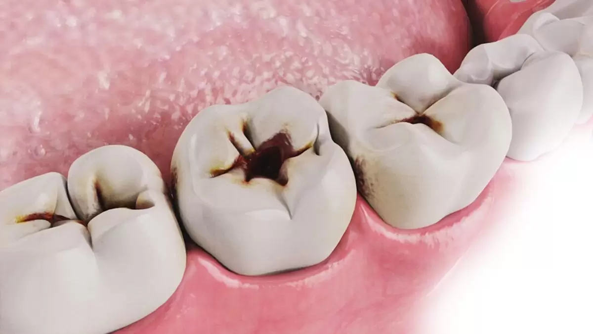 Genç Yaşta Diş Çürümesi: Nedenleri, Belirtileri ve Önleme Yöntemleri Genc Yasta Dis Curumesi