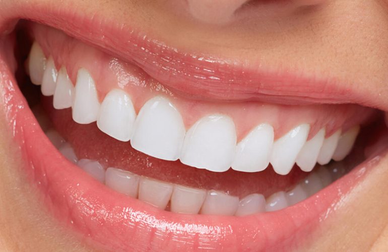Kompozit Lamina Yaptırmayı Düşünenlere 10 Altın Tavsiye Kompozit Lamina Yaptirmayi Dusunenlere 10 Altin Tavsiye