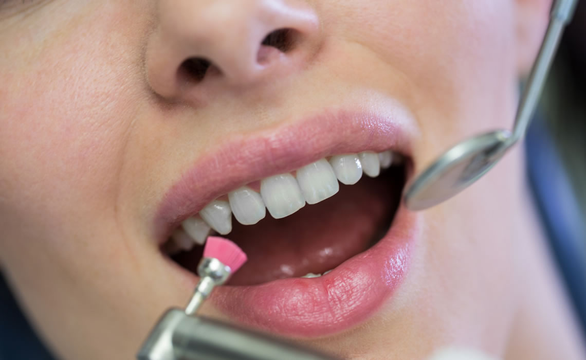 Porselen Kaplama Dis Temizligi 1