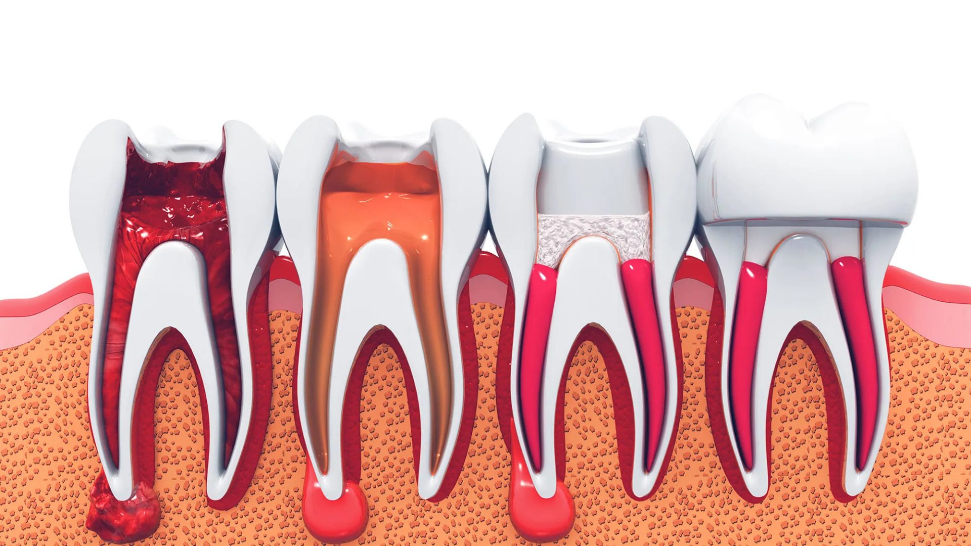 Ankara Kanal Tedavisi Fiyatları 2025 Ankara Kanal Tedavisi Fiyatları