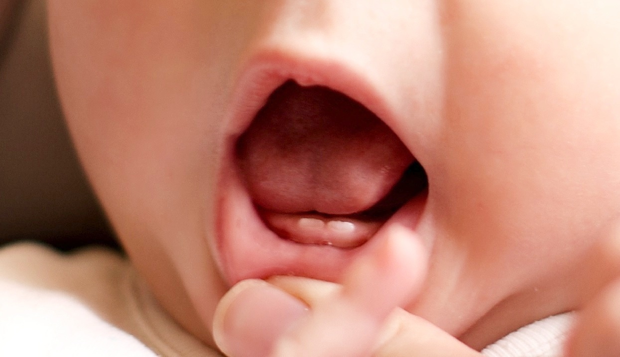 Bebeklerde Diş Çıkarma Belirtileri