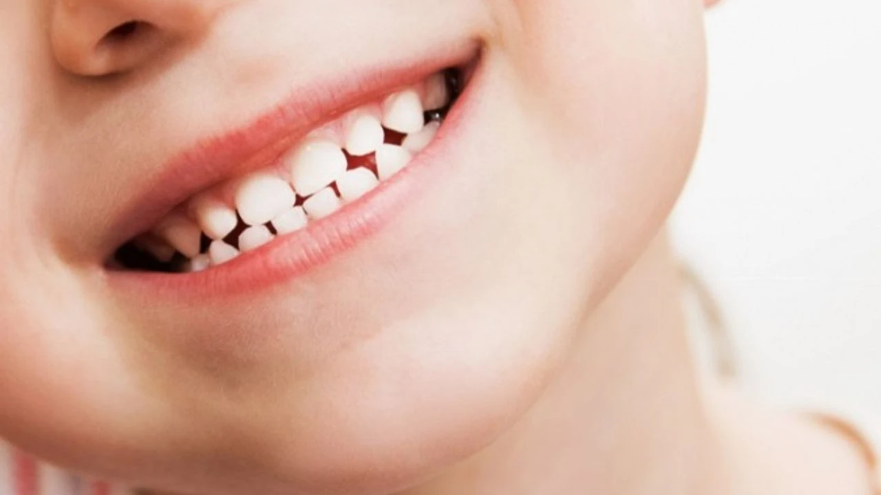 Çocuklarda Diş Çürüğü Nedenleri Cocuklarda Dis Curugu Nedenleri