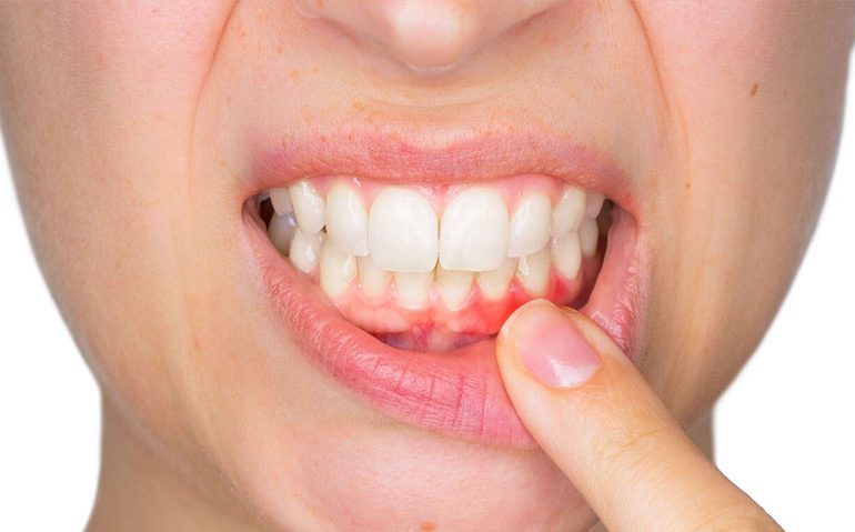 Diş İltihabına Ne İyi Gelir? Dis Iltihabina Ne Iyi Gelir