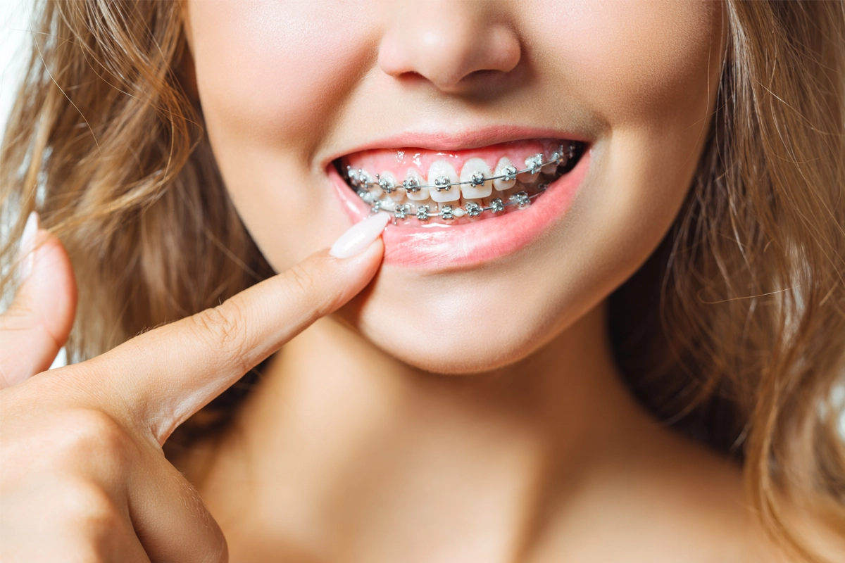 Diş Teli Takılması Ne Kadar Sürer