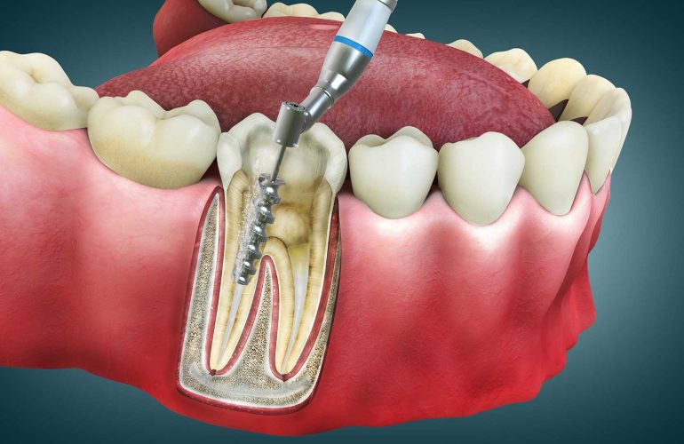 Ankara Kanal Tedavisi: Ağrısız ve Etkili Endodontik Uygulama Rehberi Kanal Tedavisi