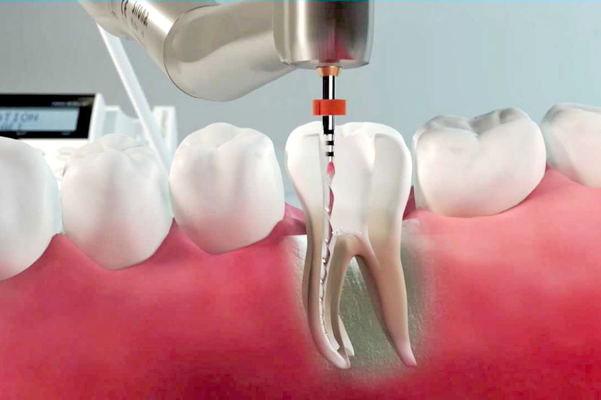 Kanal Tedavisi Sonrası Ağrı