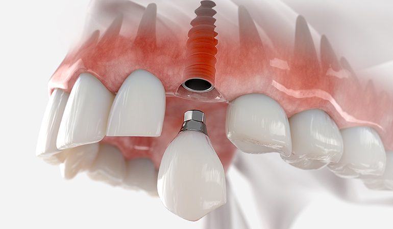 Ön Diş İmplantı Nedir? Estetik ve Kalıcı Gülüş İçin En İyi Çözüm! On Dis Implant
