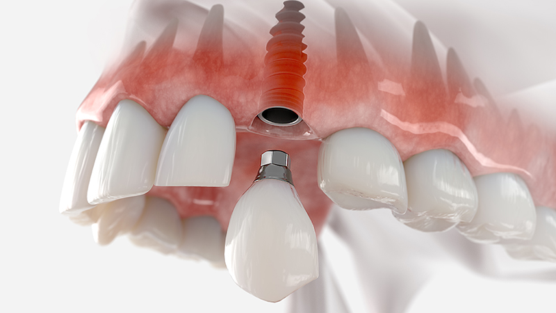 Ön Diş İmplantı Nedir? Estetik ve Kalıcı Gülüş İçin En İyi Çözüm! On Dis Implant