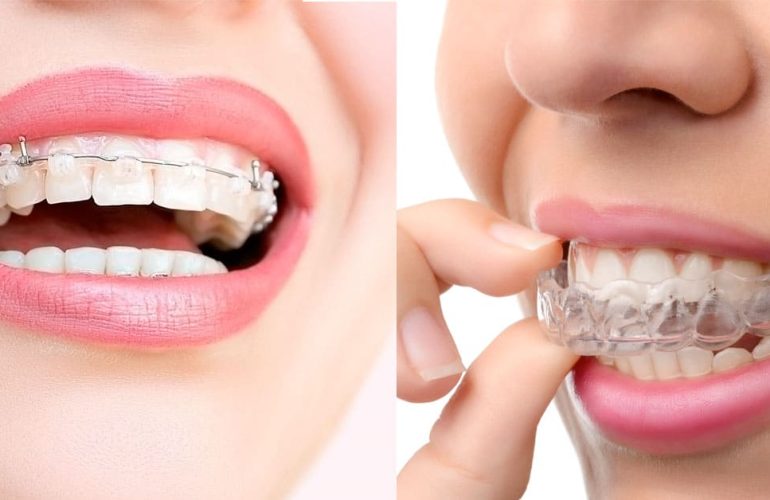 Ortodonti Tedavisi Nasıl Yapılır? Aşamaları ve Uygulama Süreci Ortodonti Tedavisi Nasil Yapilir