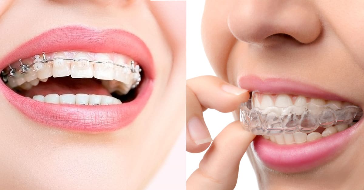 Ortodonti Tedavisi Nasıl Yapılır? Aşamaları ve Uygulama Süreci Ortodonti Tedavisi Nasil Yapilir