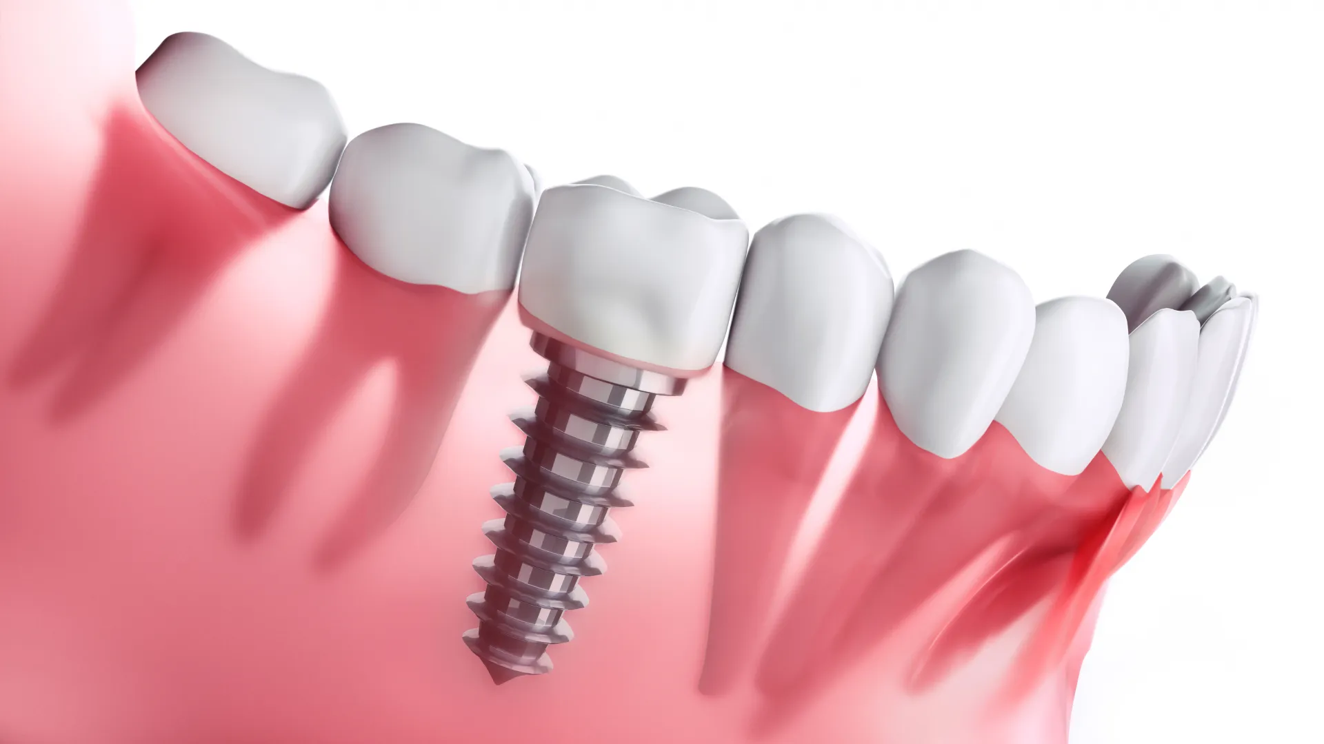 Dental Implants in Ankara – Restore Your Smile with Confidence Dental Implants