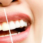 Diş Temizliği Ne Kadar Sürer