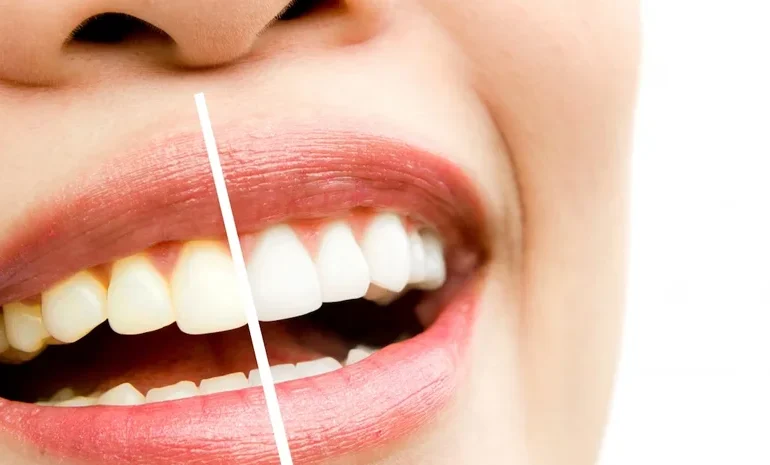 Diş Temizliği Ne Kadar Sürer? Detaylı Rehber ve Süreç Analizi Diş Temizliği Ne Kadar Sürer