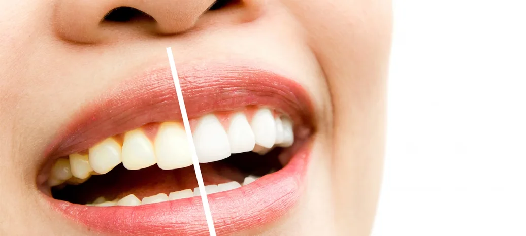 Diş Temizliği Ne Kadar Sürer