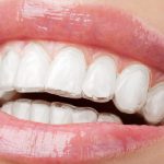 Şeffaf Diş Plağı