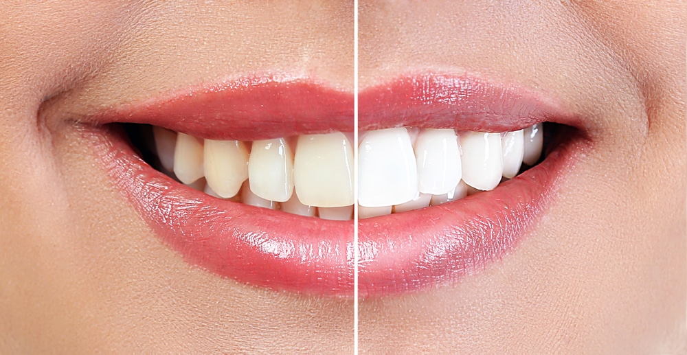 Teeth Whitening Ankara